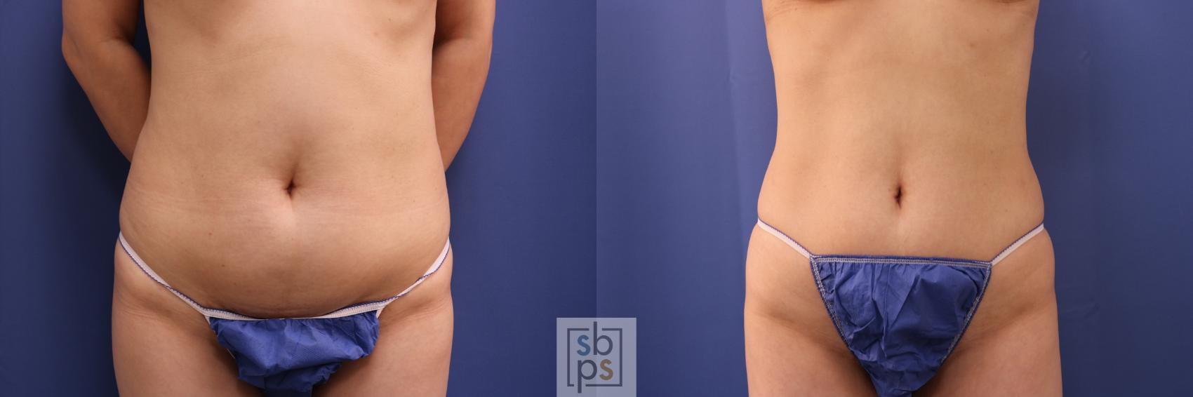 Before & After Breast Reconstruction Case 275 View #6 View in Torrance & Los Angeles, CA, CA