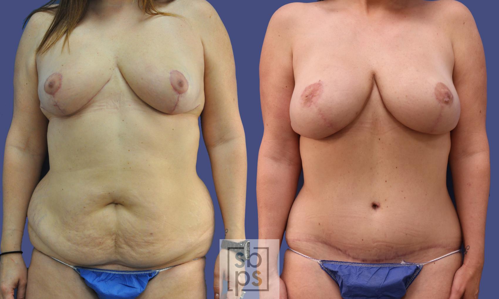 Before & After Breast Reconstruction Case 282 View #1 View in Torrance, CA