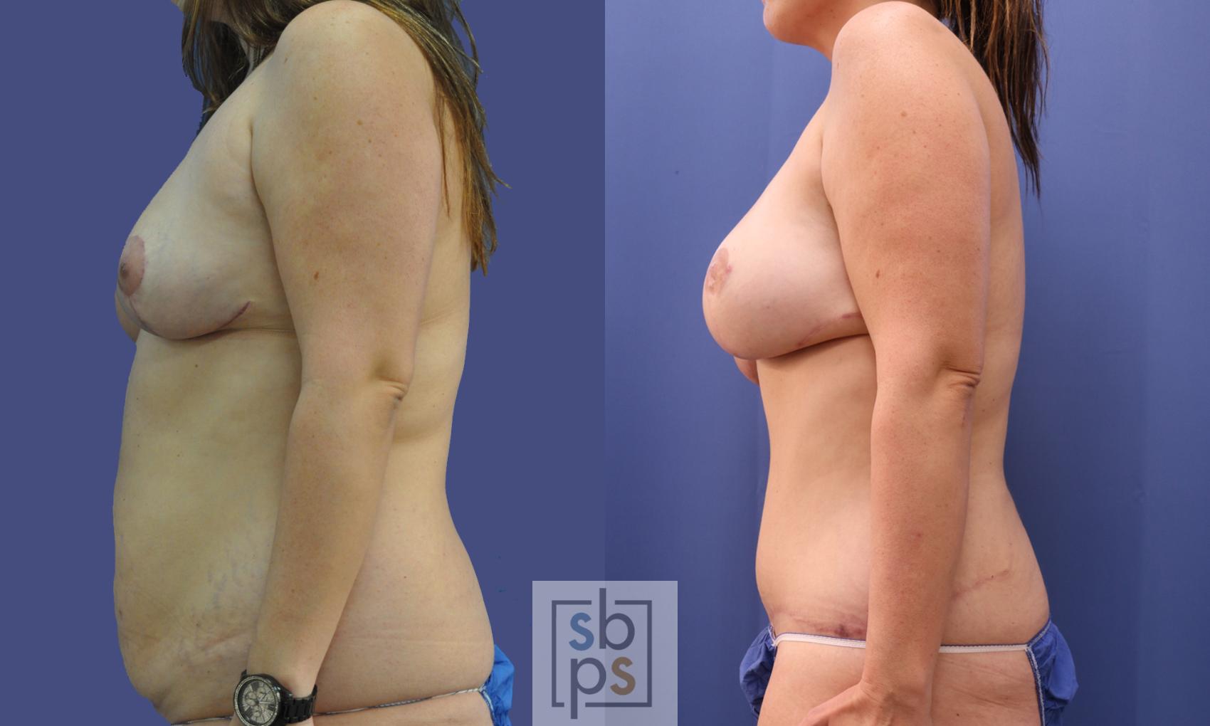 Before & After Breast Reconstruction Case 282 View #2 View in Torrance & Los Angeles, CA, CA