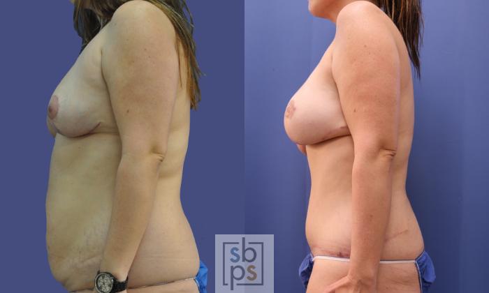 Before & After Breast Reconstruction Case 282 View #2 View in Torrance, CA