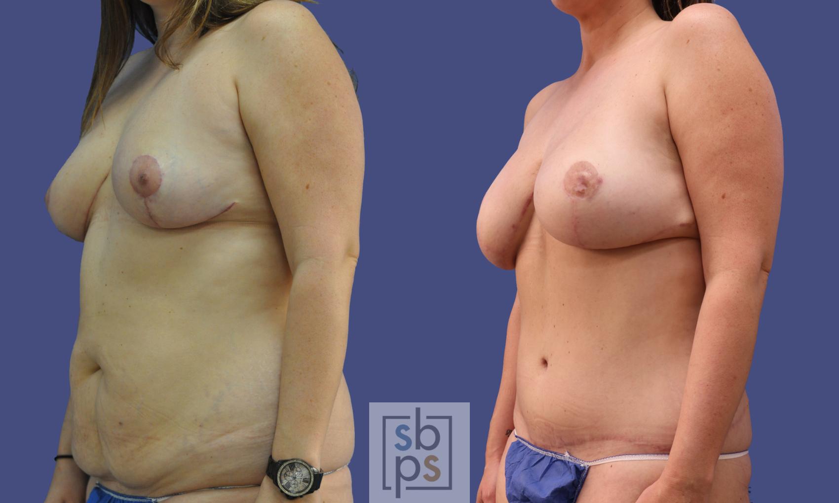 Before & After Breast Reconstruction Case 282 View #3 View in Torrance & Los Angeles, CA, CA