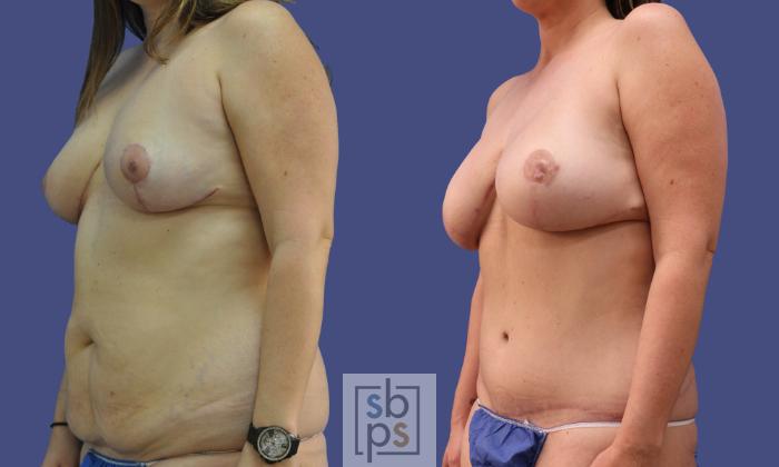 Before & After Breast Reconstruction Case 282 View #3 View in Torrance, CA