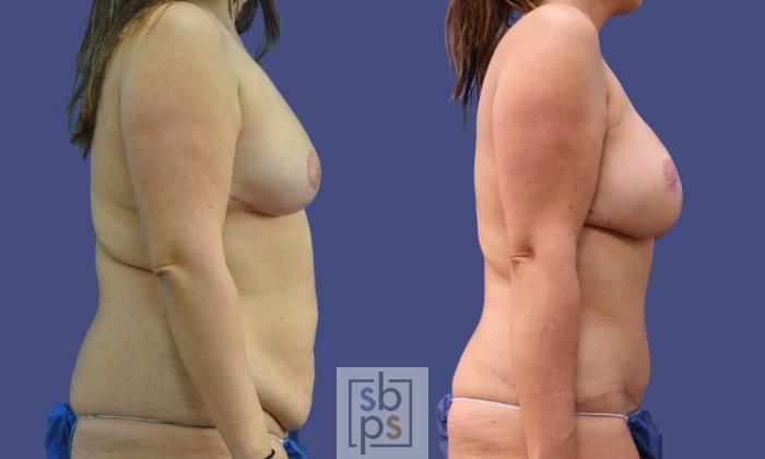 Before & After Breast Reconstruction Case 282 View #4 View in Torrance, CA