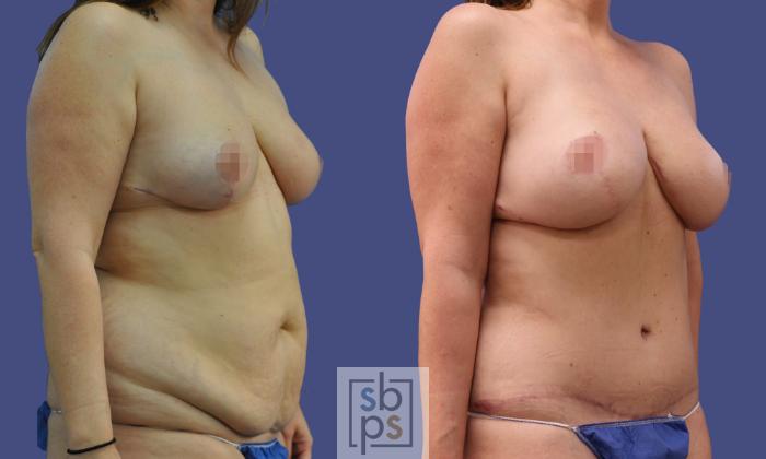 Before & After Breast Reconstruction Case 282 View #5 View in Torrance, CA
