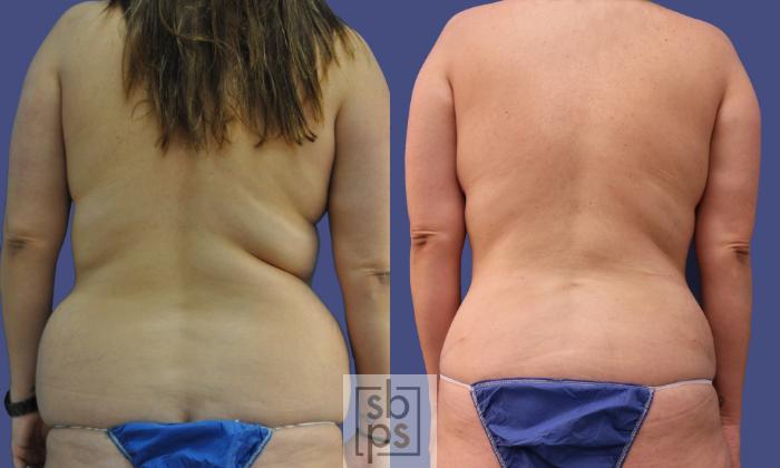 Before & After Breast Reconstruction Case 282 View #6 View in Torrance, CA