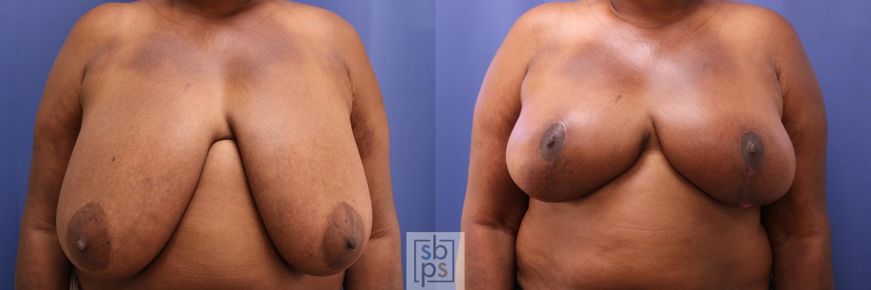 Before & After Breast Reconstruction Case 284 View #1 View in Torrance, CA