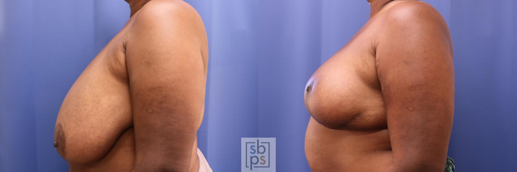 Before & After Breast Reconstruction Case 284 View #2 View in Torrance & Los Angeles, CA, CA
