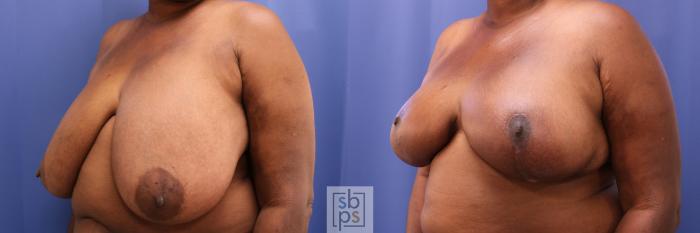 Before & After Breast Reconstruction Case 284 View #3 View in Torrance, CA