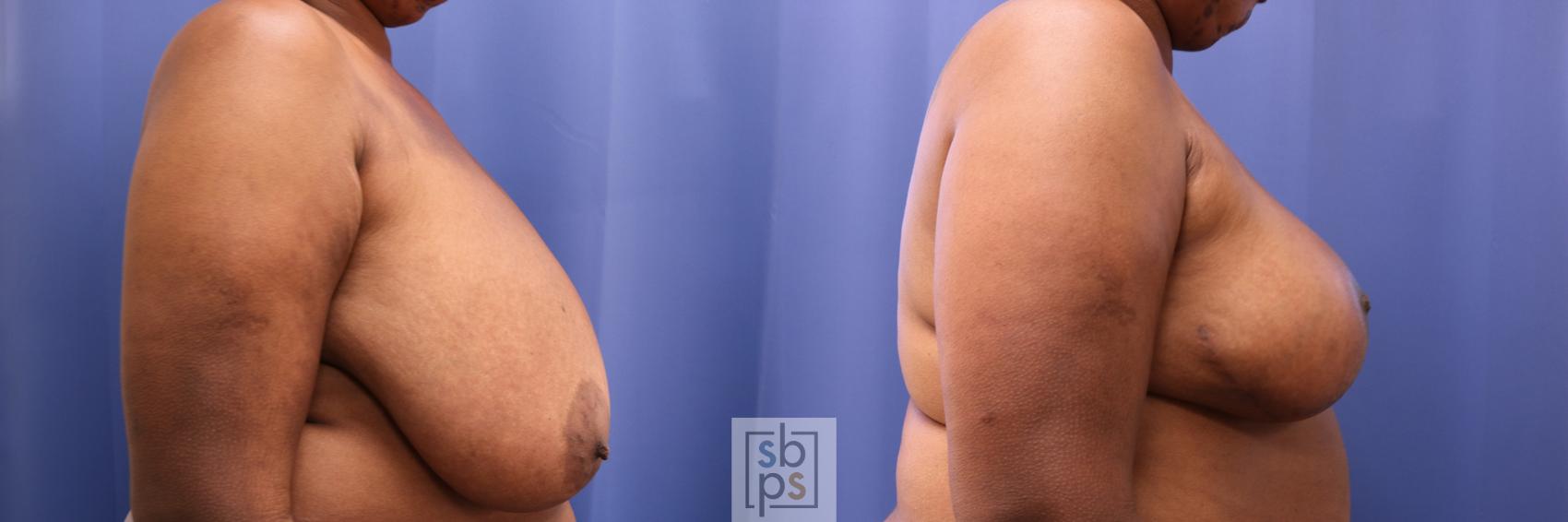 Before & After Breast Reconstruction Case 284 View #4 View in Torrance & Los Angeles, CA, CA
