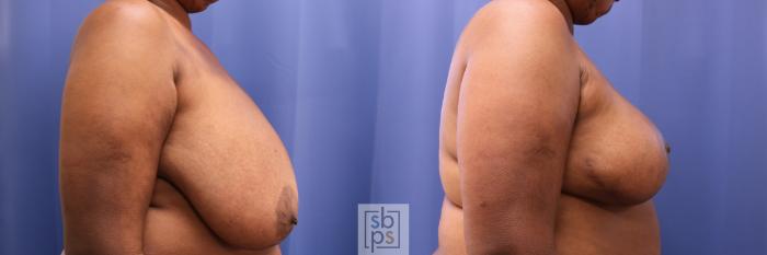 Before & After Breast Reconstruction Case 284 View #4 View in Torrance, CA