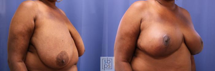 Before & After Breast Reconstruction Case 284 View #5 View in Torrance, CA