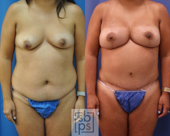 Before & After Breast Reconstruction Case 292 View #1 View in Torrance, CA