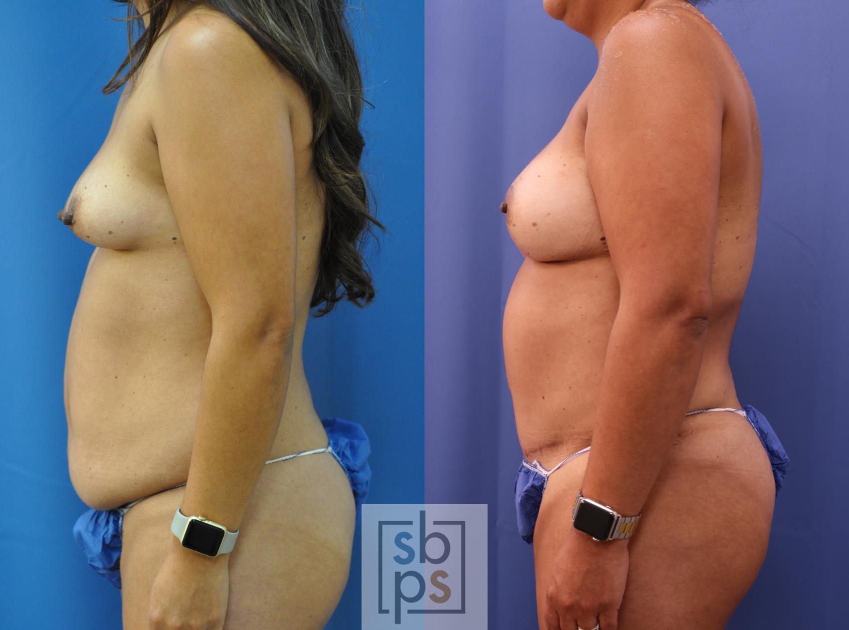 Before & After Breast Reconstruction Case 292 View #2 View in Torrance & Los Angeles, CA, CA