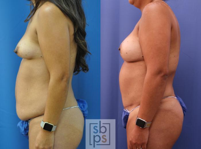 Before & After Breast Reconstruction Case 292 View #2 View in Torrance, CA