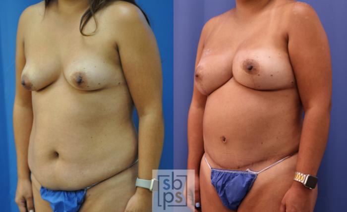 Before & After Breast Reconstruction Case 292 View #3 View in Torrance, CA