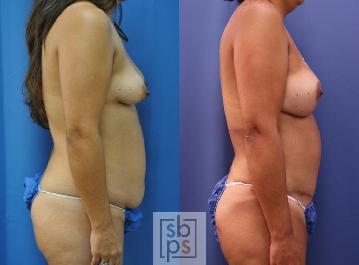 Before & After Breast Reconstruction Case 292 View #4 View in Torrance, CA