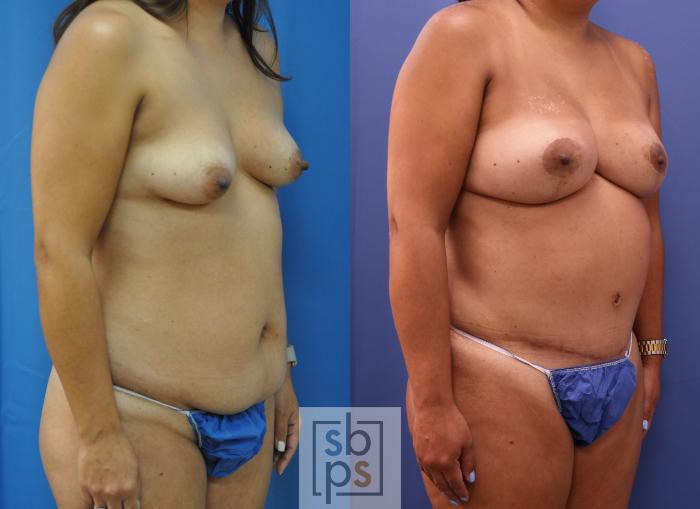 Before & After Breast Reconstruction Case 292 View #5 View in Torrance, CA