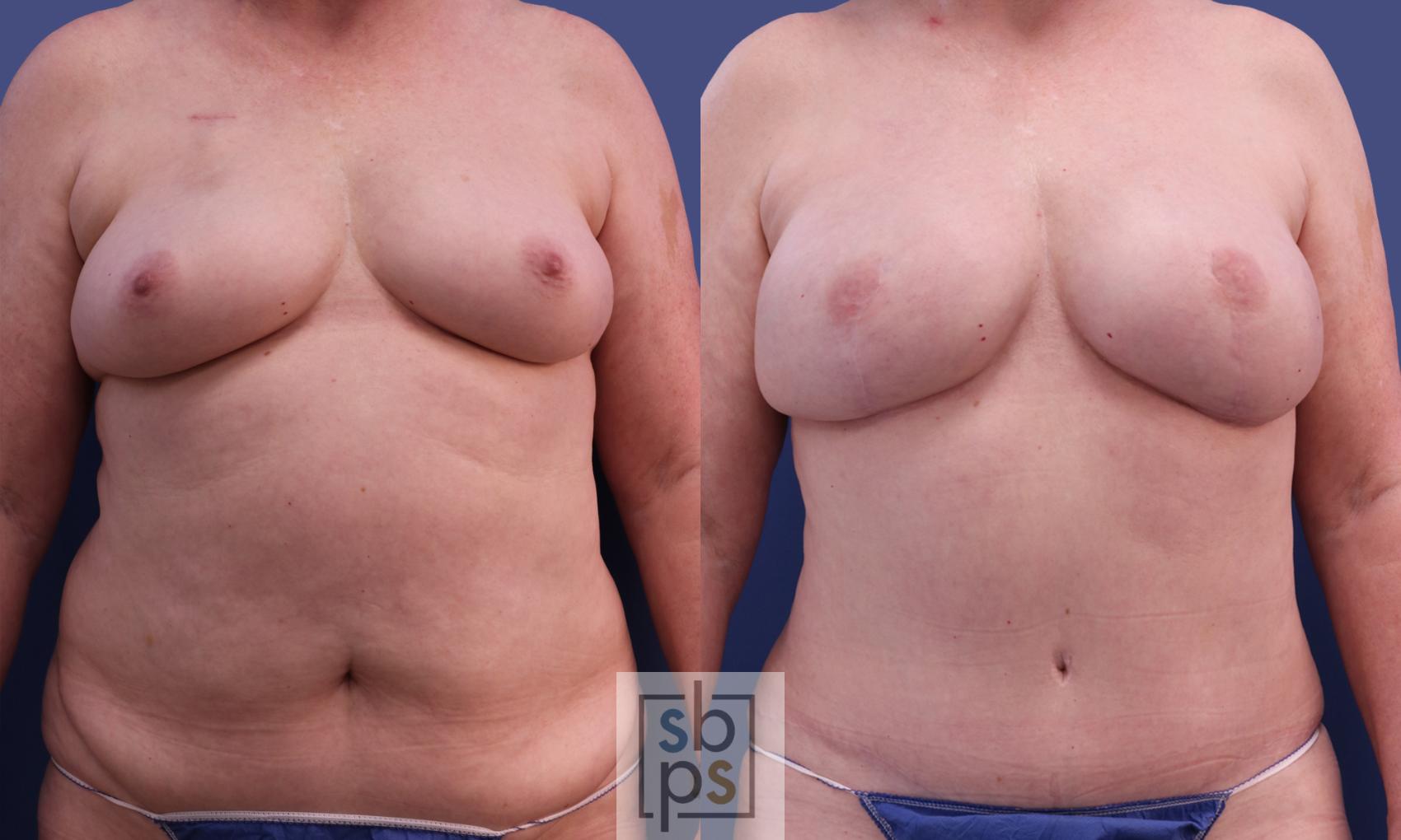 Before & After Breast Reconstruction Case 299 View #1 View in Torrance, CA