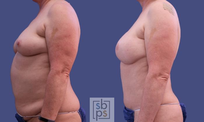 Before & After Breast Reconstruction Case 299 View #2 View in Torrance, CA