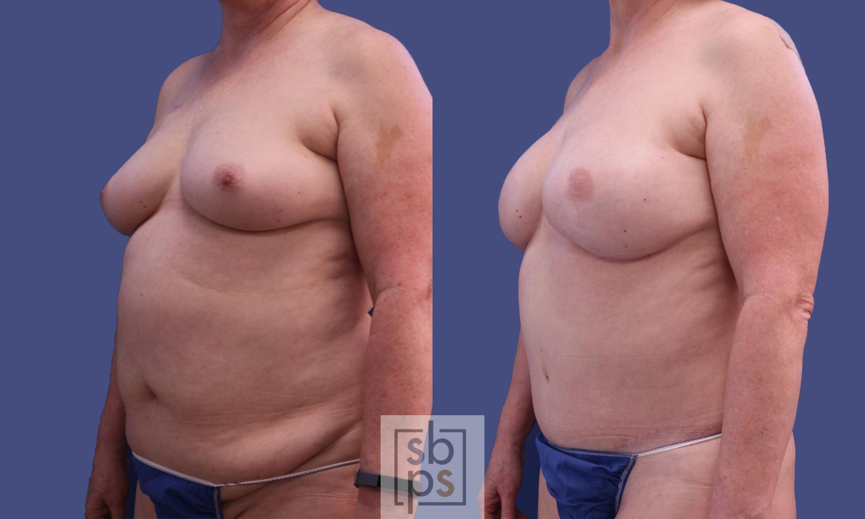 Before & After Breast Reconstruction Case 299 View #3 View in Torrance & Los Angeles, CA, CA