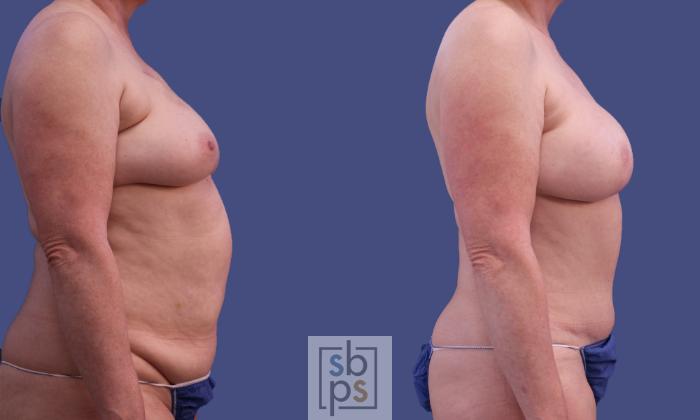 Before & After Breast Reconstruction Case 299 View #4 View in Torrance, CA