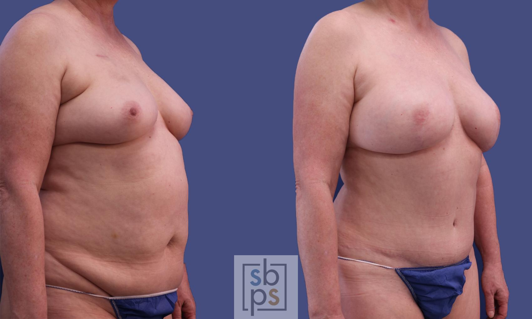 Before & After Breast Reconstruction Case 299 View #5 View in Torrance & Los Angeles, CA, CA