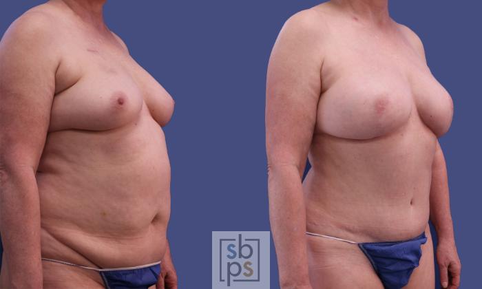 Before & After Breast Reconstruction Case 299 View #5 View in Torrance, CA