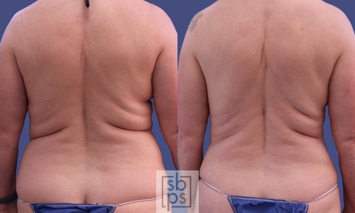 Before & After Breast Reconstruction Case 299 View #6 View in Torrance, CA