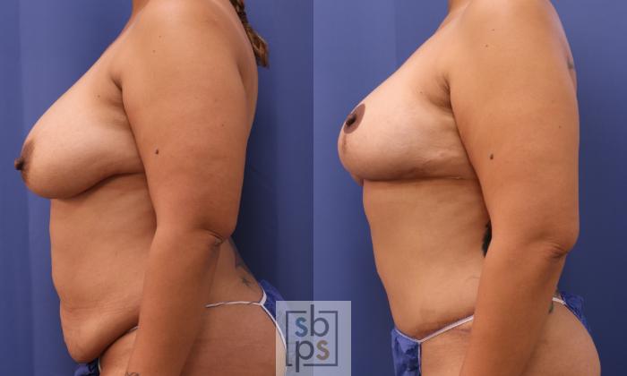 Before & After Breast Reconstruction Case 301 View #2 View in Torrance, CA