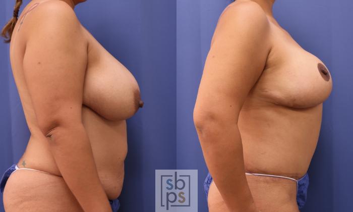 Before & After Breast Reconstruction Case 301 View #4 View in Torrance, CA