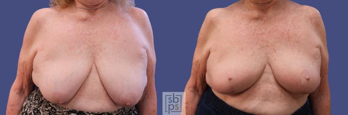 Before & After Breast Reconstruction Case 311 View #1 View in Torrance, CA