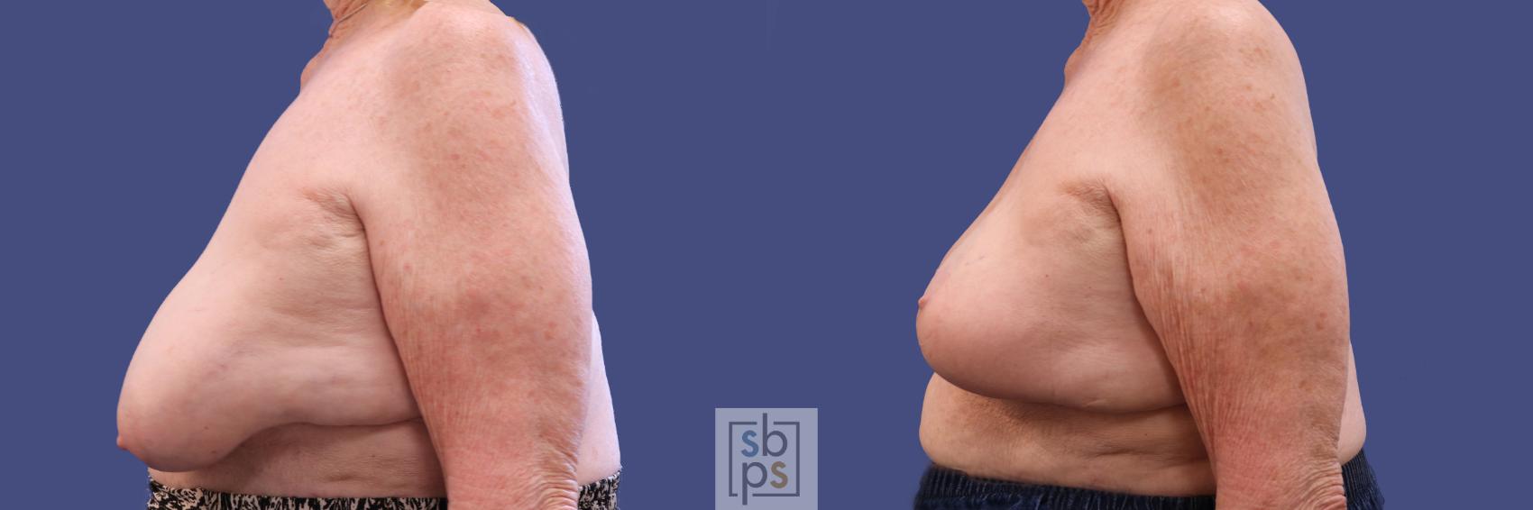 Before & After Breast Reconstruction Case 311 View #2 View in Los Angeles, Torrance & Long Beach, CA