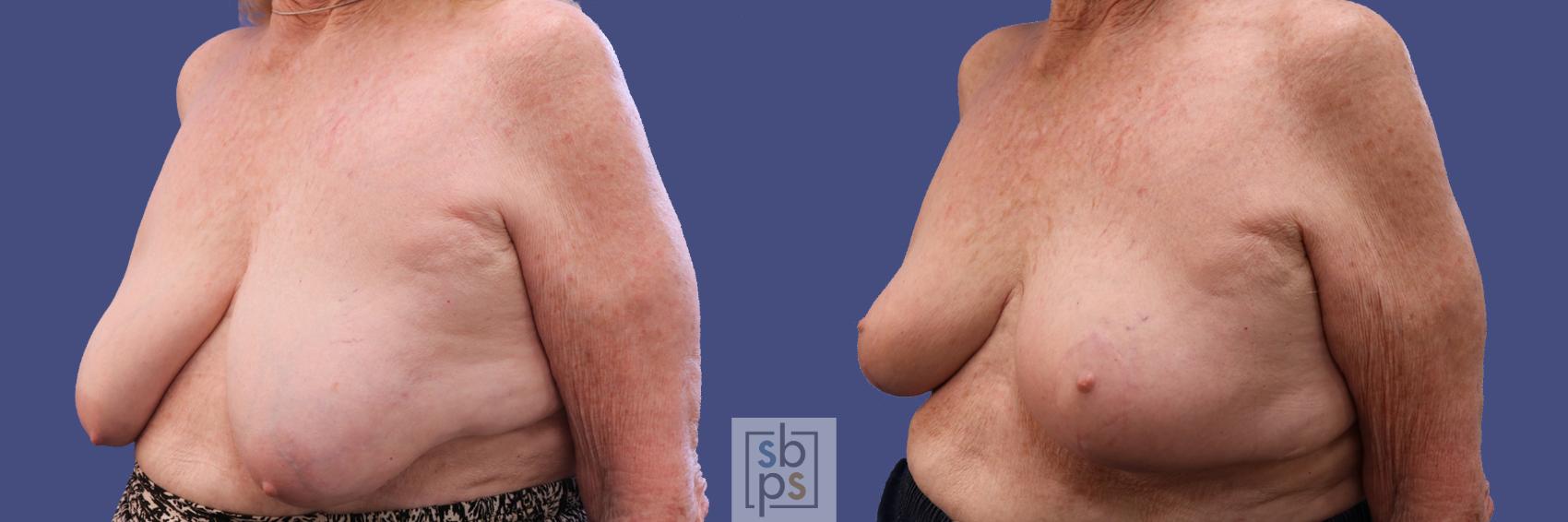 Before & After Breast Reconstruction Case 311 View #3 View in Los Angeles, Torrance & Long Beach, CA