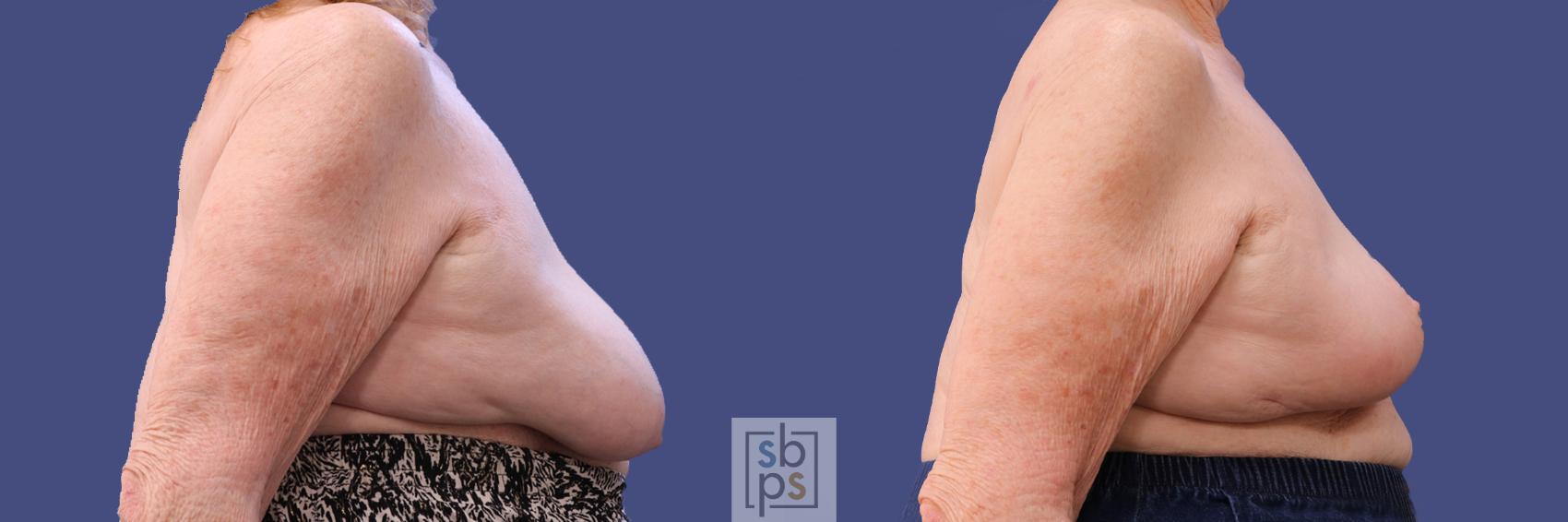 Before & After Breast Reconstruction Case 311 View #4 View in Los Angeles, Torrance & Long Beach, CA