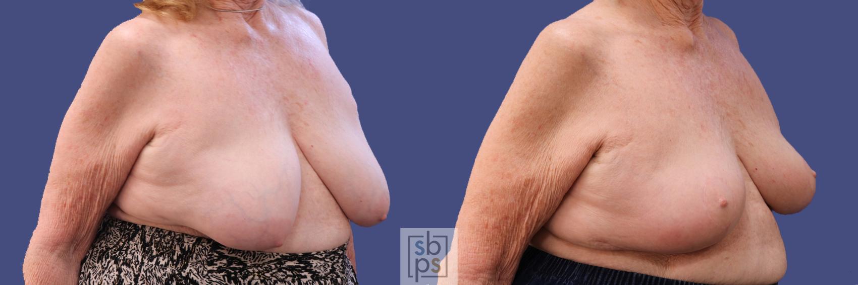Before & After Breast Reconstruction Case 311 View #5 View in Los Angeles, Torrance & Long Beach, CA