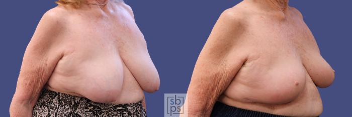 Before & After Breast Reconstruction Case 311 View #5 View in Torrance, CA