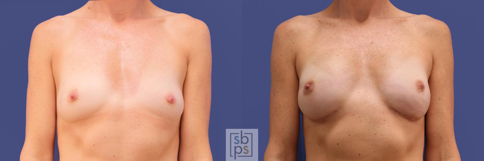 Before & After Breast Reconstruction Case 314 View #1 View in Torrance, CA