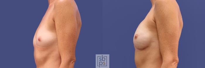Before & After Breast Reconstruction Case 314 View #2 View in Torrance, CA