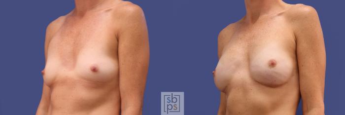 Before & After Breast Reconstruction Case 314 View #3 View in Torrance, CA