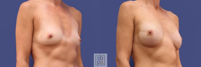 Before & After Breast Reconstruction Case 314 View #5 View in Torrance, CA