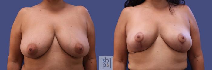 Before & After Breast Reconstruction Case 316 View #1 View in Torrance, CA