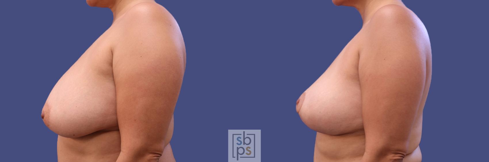 Before & After Breast Reconstruction Case 316 View #2 View in Los Angeles, Torrance & Long Beach, CA