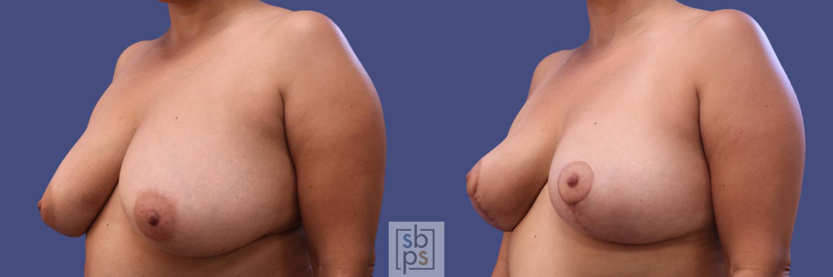 Before & After Breast Reconstruction Case 316 View #3 View in Los Angeles, Torrance & Long Beach, CA