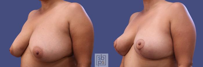 Before & After Breast Reconstruction Case 316 View #3 View in Torrance, CA