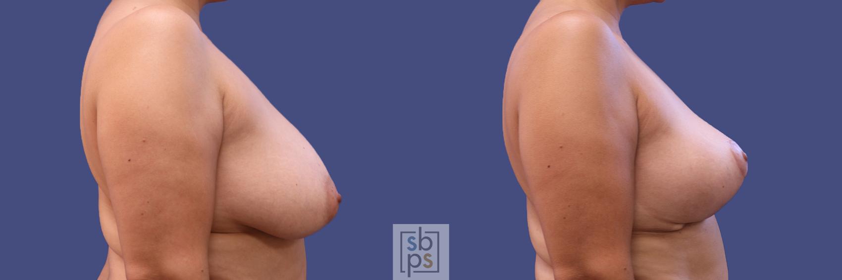 Before & After Breast Reconstruction Case 316 View #4 View in Los Angeles, Torrance & Long Beach, CA