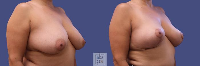 Before & After Breast Reconstruction Case 316 View #5 View in Torrance, CA