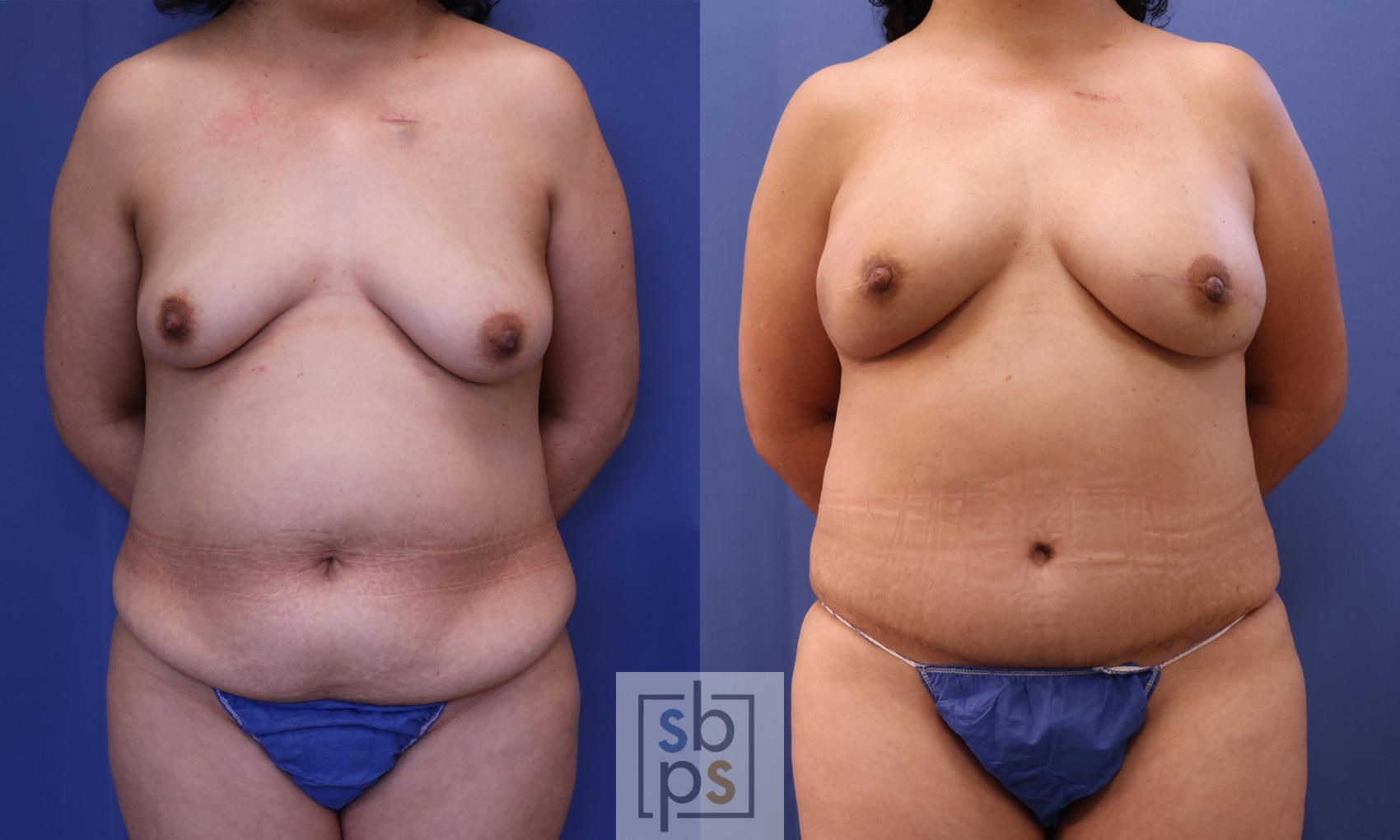 Before & After Breast Reconstruction Case 323 View #1 View in Torrance, CA