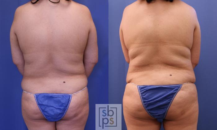 Before & After Breast Reconstruction Case 323 View #2 View in Torrance, CA