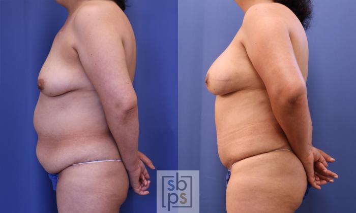 Before & After Breast Reconstruction Case 323 View #3 View in Torrance, CA
