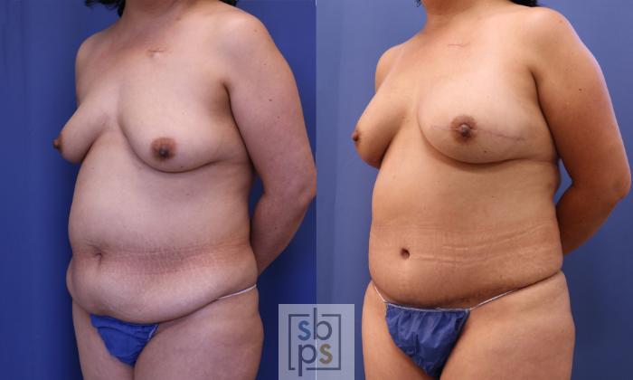 Before & After Breast Reconstruction Case 323 View #4 View in Torrance, CA
